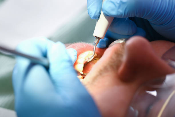 Best Emergency Treatment for Oral Infections in University Park, MD